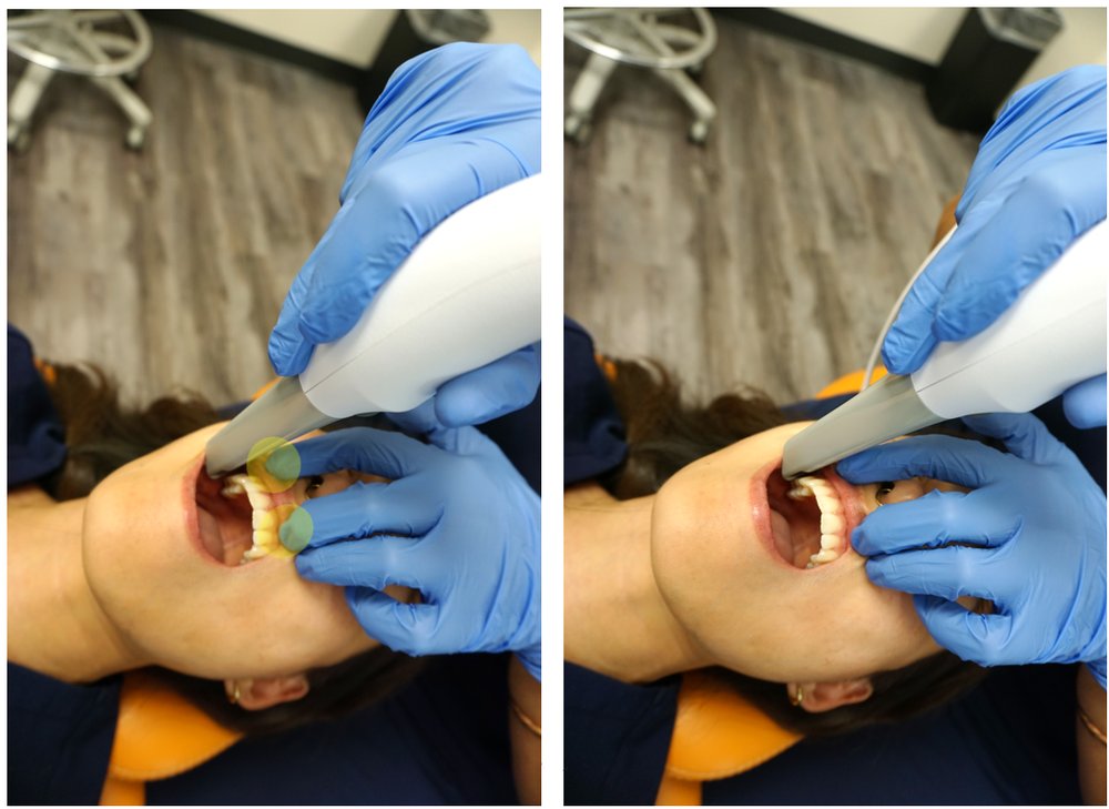 Using fingers and scanner to retract lip and cheek, 45 degree and 90 degree passes